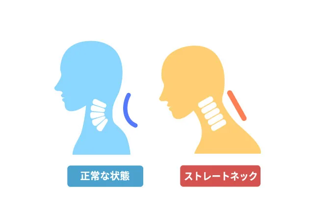正常な状態とストレートネック